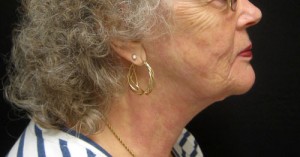 Neck Lift patient after