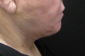 Patient displaying results of NYC necklift