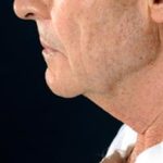 Male patient before a neck lift