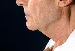 Male patient before a neck lift