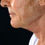 Results of NYC necklift from Dr. Cangello