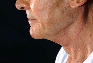 Results of NYC necklift from Dr. Cangello