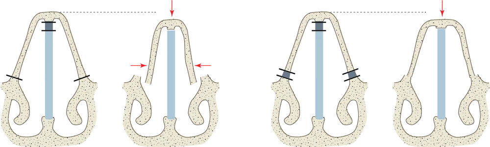 preservation rhinoplasty diagram