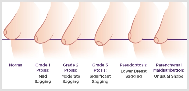 Breast lift ptosis diagram